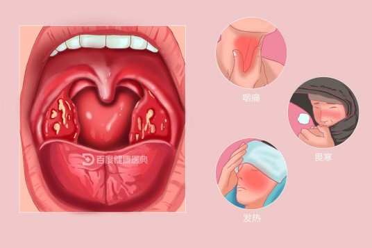 小儿化脓性扁桃体炎