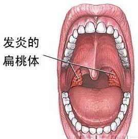 扁桃体(人体器官)