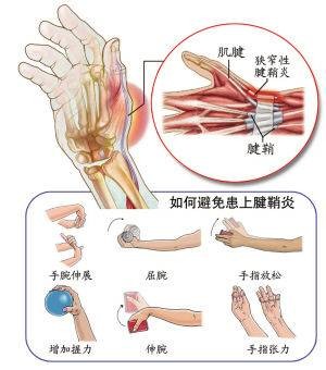手指腱鞘炎