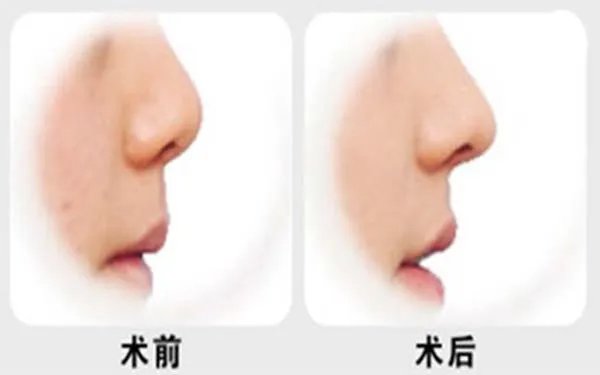 隆鼻整形北京哪家医院好？