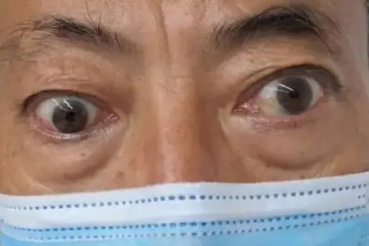 眼球突出照片