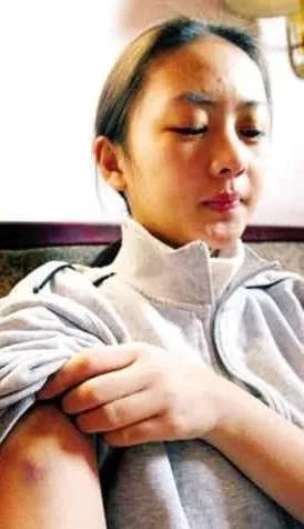 张默殴打女友童谣照片曝光 揭张默暴打原因