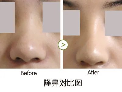 海口玻尿酸隆鼻哪家医院比较好?海口玻尿酸隆鼻价格一览表