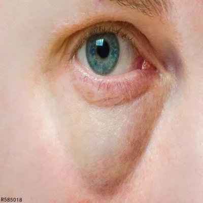 做眼袋手术需要多少钱 做眼袋手术的收费标准揭晓