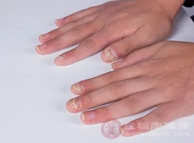 灰指甲怎么办 这一招帮你快速搞定灰指甲