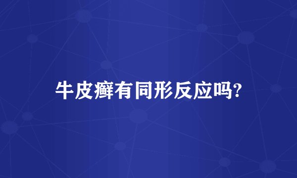 牛皮癣有同形反应吗?