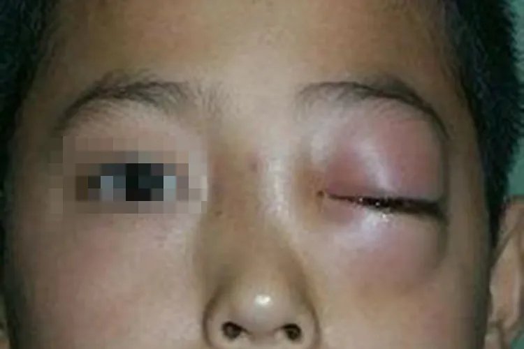 眼球突出照片