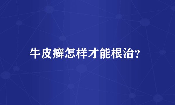 牛皮癣怎样才能根治？