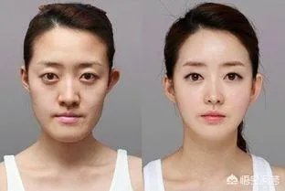 如何看待长沙女子脸部整容整出八个坑,恢复期要很久?