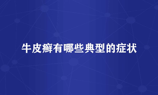 牛皮癣有哪些典型的症状