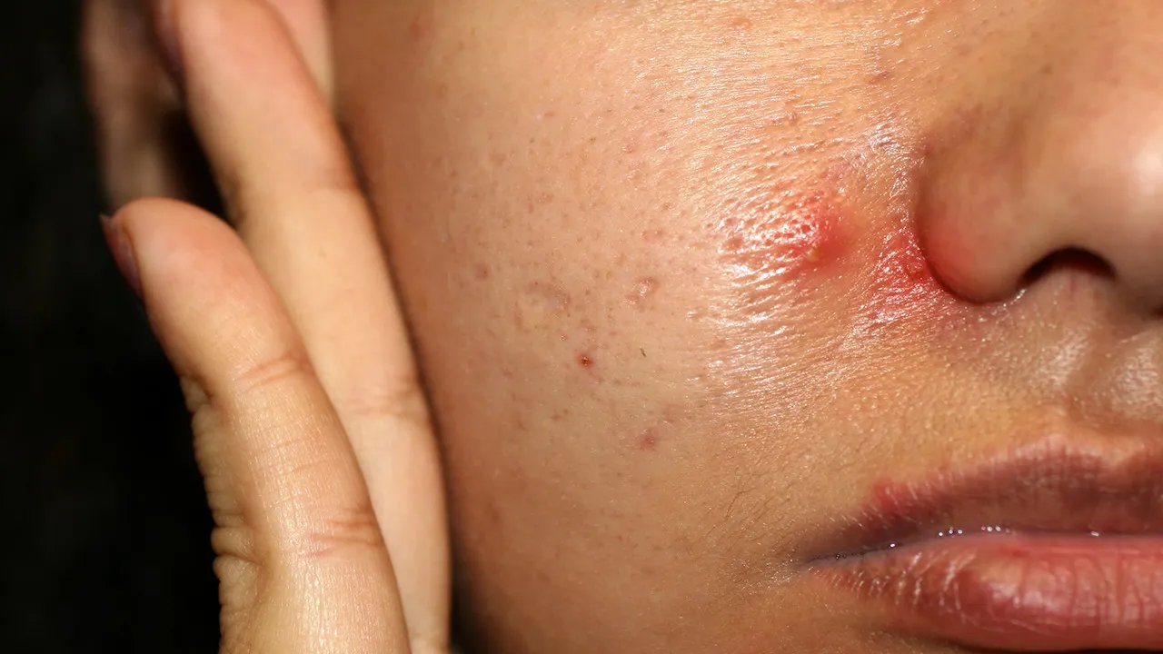 激光可以去痘印吗
