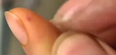 住宾馆遭老鼠咬伤怎么办?