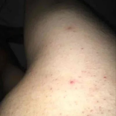 过敏什么症状图片