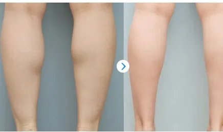 打botox瘦腿效果怎样