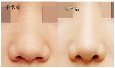 鼻翼肥厚怎么治疗